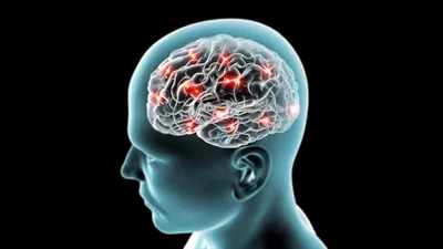 brain stroke  जानें ब्रेन स्ट्रोक और ब्रेन हेमरेज में अंतर  कैसे करें इससे बचाव