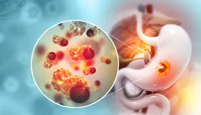 appendix burst treatment  अपेंडिक्स फटना कितना खतरनाक  क्या है सही उपचार